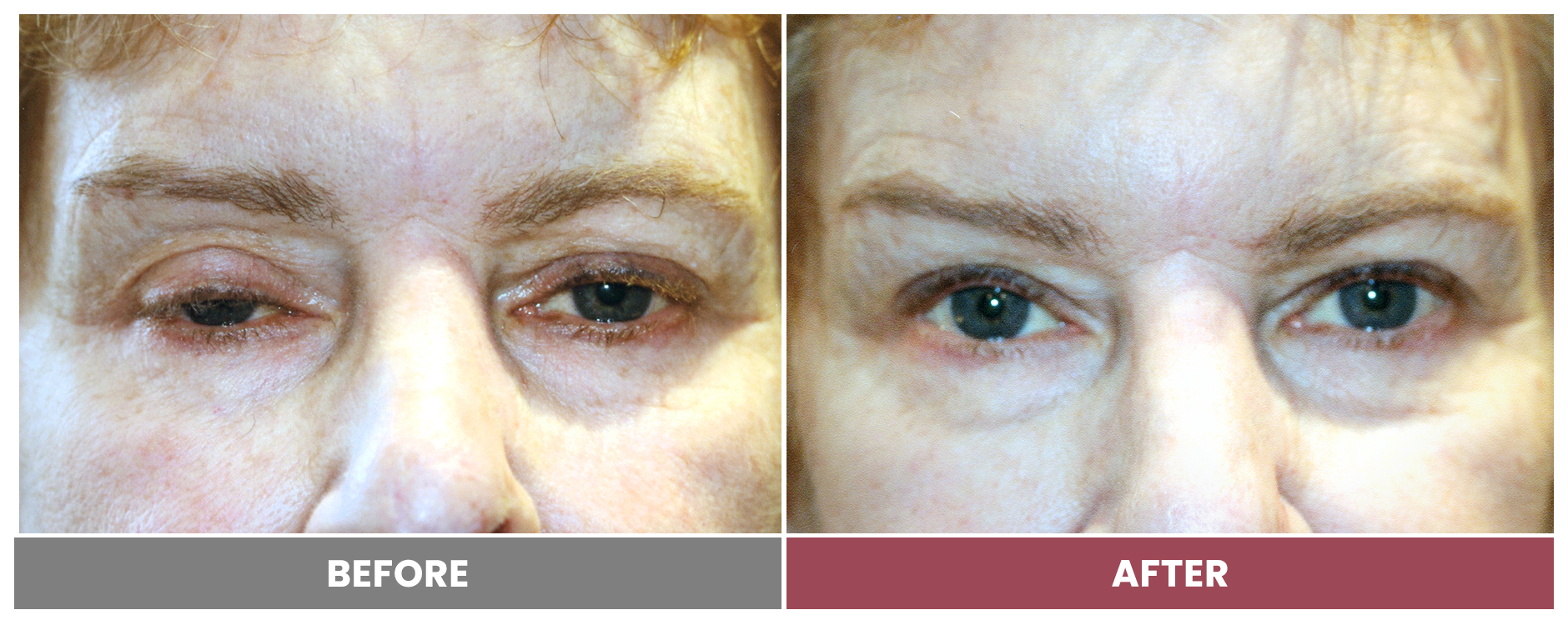 PTOSIS REPAIR - Case 53